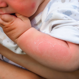 Baby mit Sonnenbrand am Arm