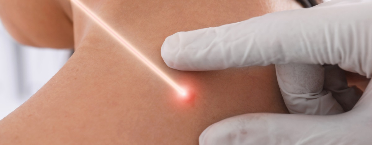 Laserstrahl mit dem die Haut einer Patientin behandelt wird